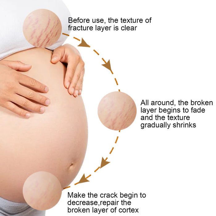 Eelhoe Total Erase Stretch Marks Obesity & Pregnancy Repair CreamEELHOE Total Erase Stretch Marks Cream – Pregnancy & Weight Repair Care EELHOE COSMETICS
