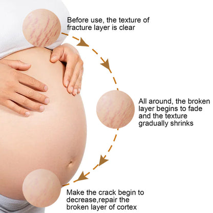 Eelhoe Total Erase Stretch Marks Obesity & Pregnancy Repair CreamEELHOE Total Erase Stretch Marks Cream – Pregnancy & Weight Repair Care EELHOE COSMETICS