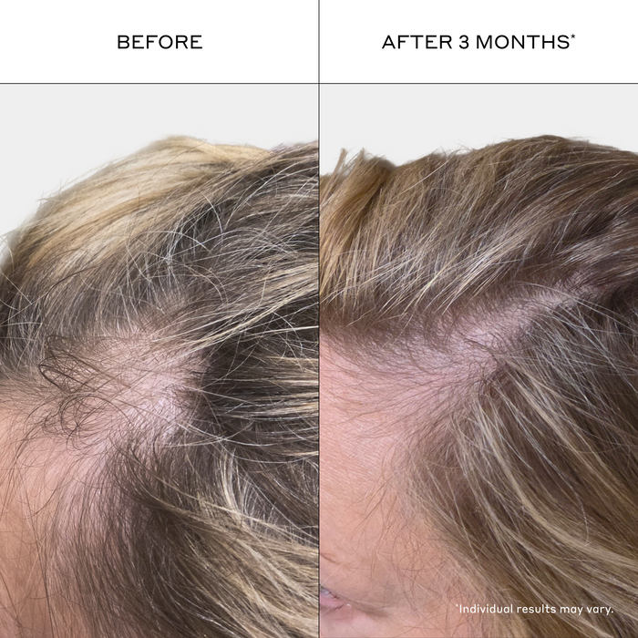 Zenagen Revolve Women's Shampoo before and after photos showing visibly fuller-looking hair and reduced appearance of thinning after 3 months of consistent use.