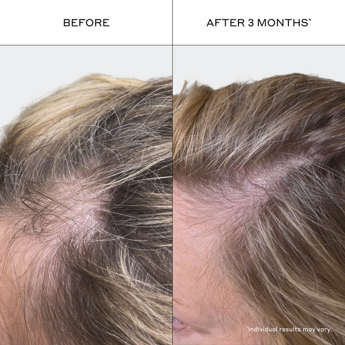 Before and after comparison of thinning hair appearance showing visibly fuller-looking hair after three months of using Zenagen Revolve shampoo and conditioner, individual results may vary